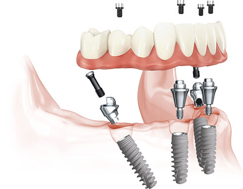 Diagram of All-on-4 treatment